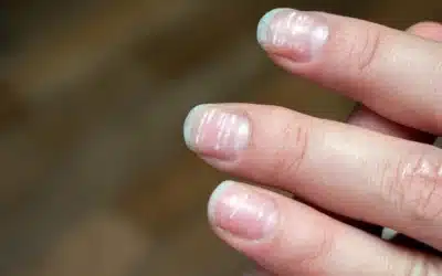 Here’s What Those White Spots On Your Nails Mean & How You Can Prevent Them