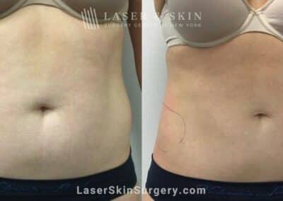 CoolSculpting treatments to sculpt the abdomen