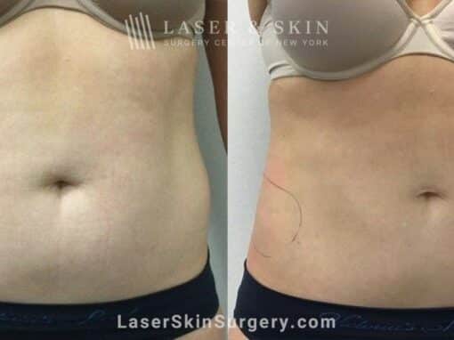 CoolSculpting treatments to sculpt the abdomen