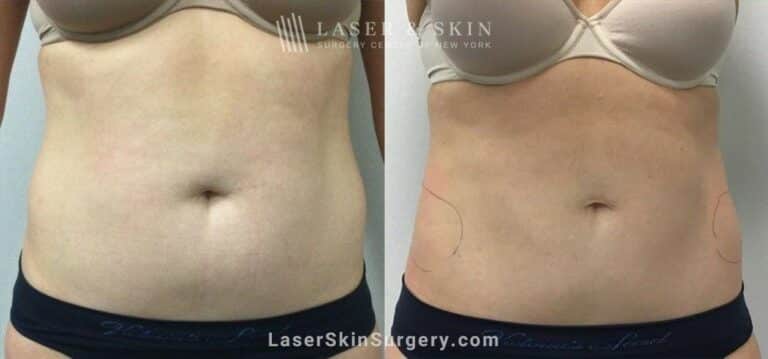 CoolSculpting treatments to sculpt the abdomen