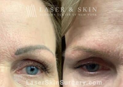 Picoplus laser for permanent makeup removal on eyebrows