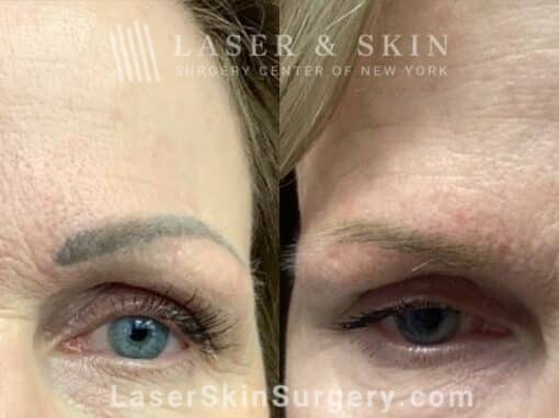 Picoplus laser for permanent makeup removal on eyebrows