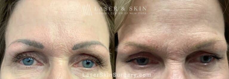 Picoplus laser for permanent makeup removal on eyebrows