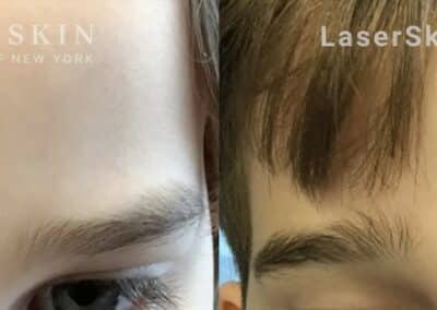 Ruby laser to treat dark spot between child’s eyebrows