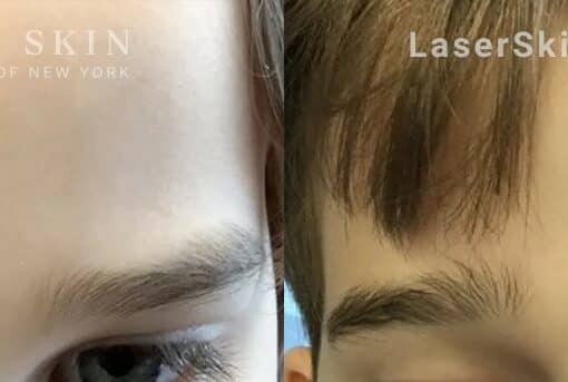 Ruby laser to treat dark spot between child’s eyebrows