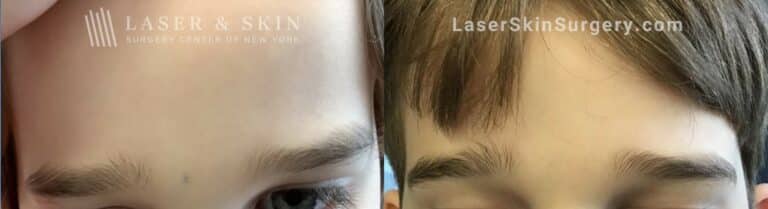 Ruby laser to treat dark spot between child’s eyebrows