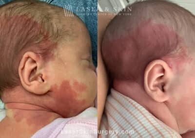 Vbeam laser to treat port wine birthmark on baby’s head