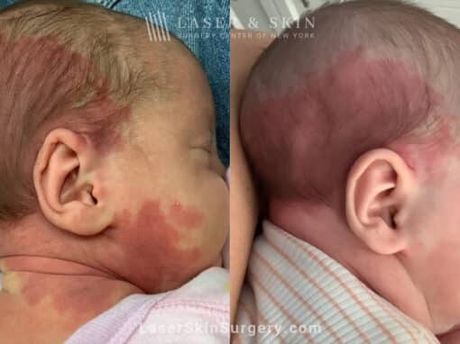 Vbeam laser to treat port wine birthmark on baby’s head