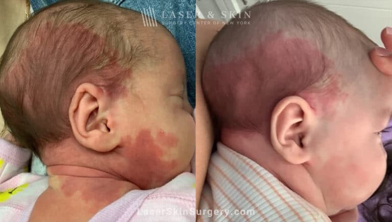 Vbeam laser to treat port wine birthmark on baby’s head