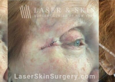 Mohs surgery to treat skin cancer near the eye