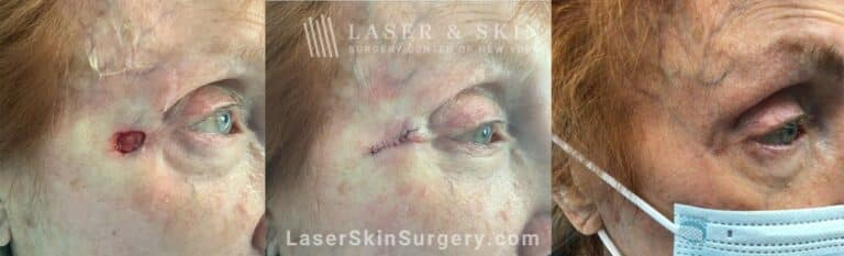 Mohs surgery to treat skin cancer near the eye