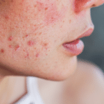 Evaluation of Acne Home Remedies by Dermatologists: Toothpaste and Raw Eggs Included