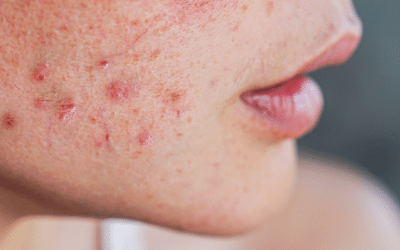 Evaluation of Acne Home Remedies by Dermatologists: Toothpaste and Raw Eggs Included