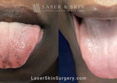 Picoplus laser to treat dark spots on the tongue