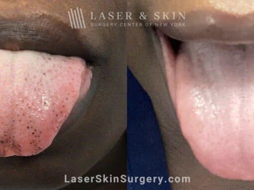 Picoplus laser to treat dark spots on the tongue