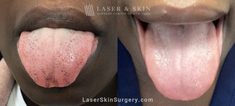 Picoplus laser to treat dark spots on the tongue