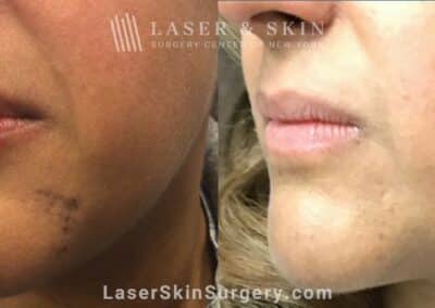 Picoplus laser for dark spots on the chin