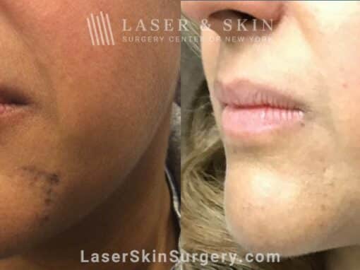 Picoplus laser for dark spots on the chin