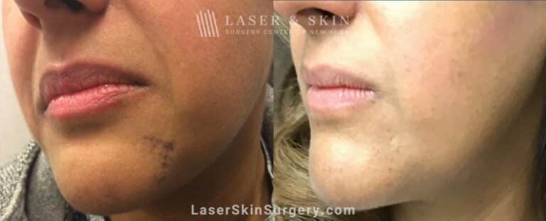 Picoplus laser for dark spots on the chin
