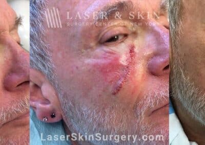 Mohs surgery to treat skin cancer on the cheek