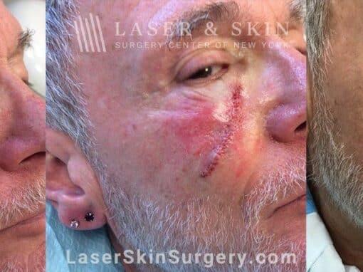 Mohs surgery to treat skin cancer on the cheek