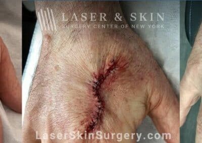 Mohs surgery to treat skin cancer on the hand