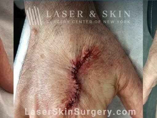 Mohs surgery to treat skin cancer on the hand