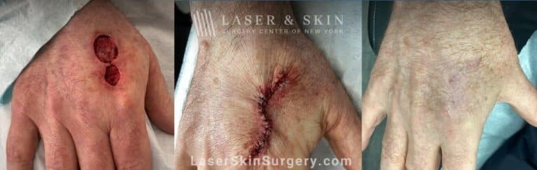 Mohs surgery to treat skin cancer on the hand