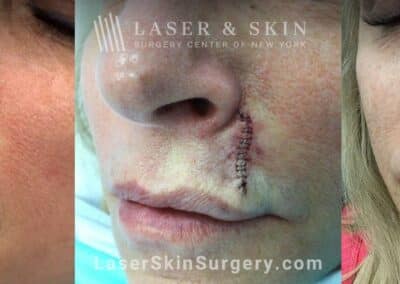 Mohs surgery to treat skin cancer above the lip