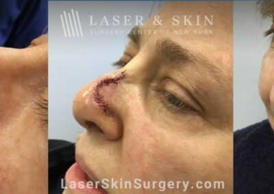 Mohs surgery to treat skin cancer on the tip of the nose