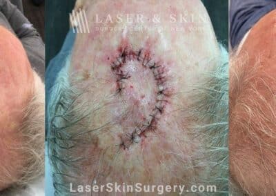 Mohs surgery to treat skin cancer on the scalp