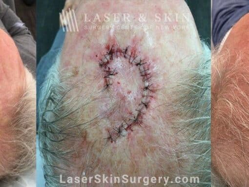 Mohs surgery to treat skin cancer on the scalp