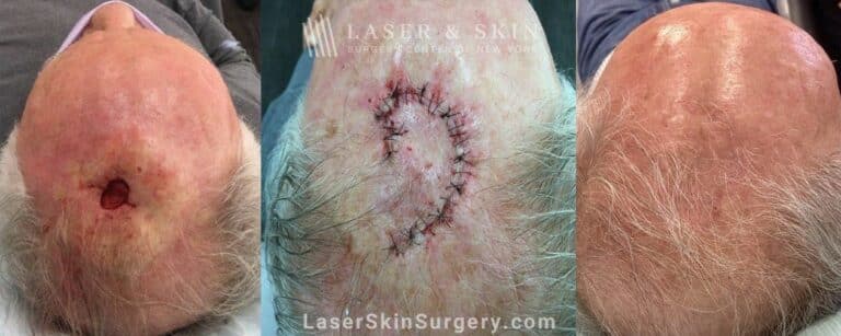 Mohs surgery to treat skin cancer on the scalp