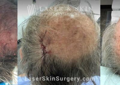 Mohs surgery to treat skin cancer on the scalp