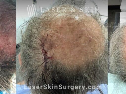 Mohs surgery to treat skin cancer on the scalp