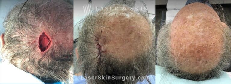 Mohs surgery to treat skin cancer on the scalp