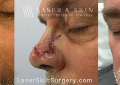 Mohs surgery to treat skin cancer on the nose