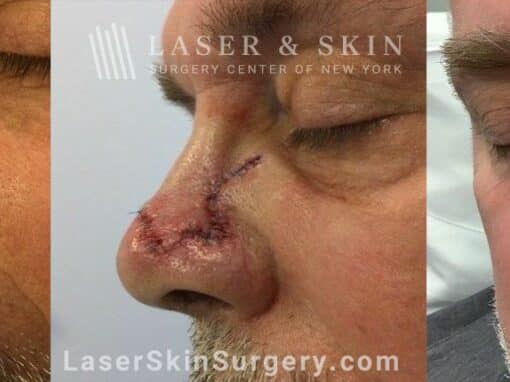 Mohs surgery to treat skin cancer on the nose