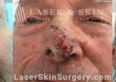 Mohs surgery to treat skin cancer on the nose