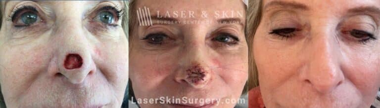 Mohs surgery to treat skin cancer on the tip of the nose