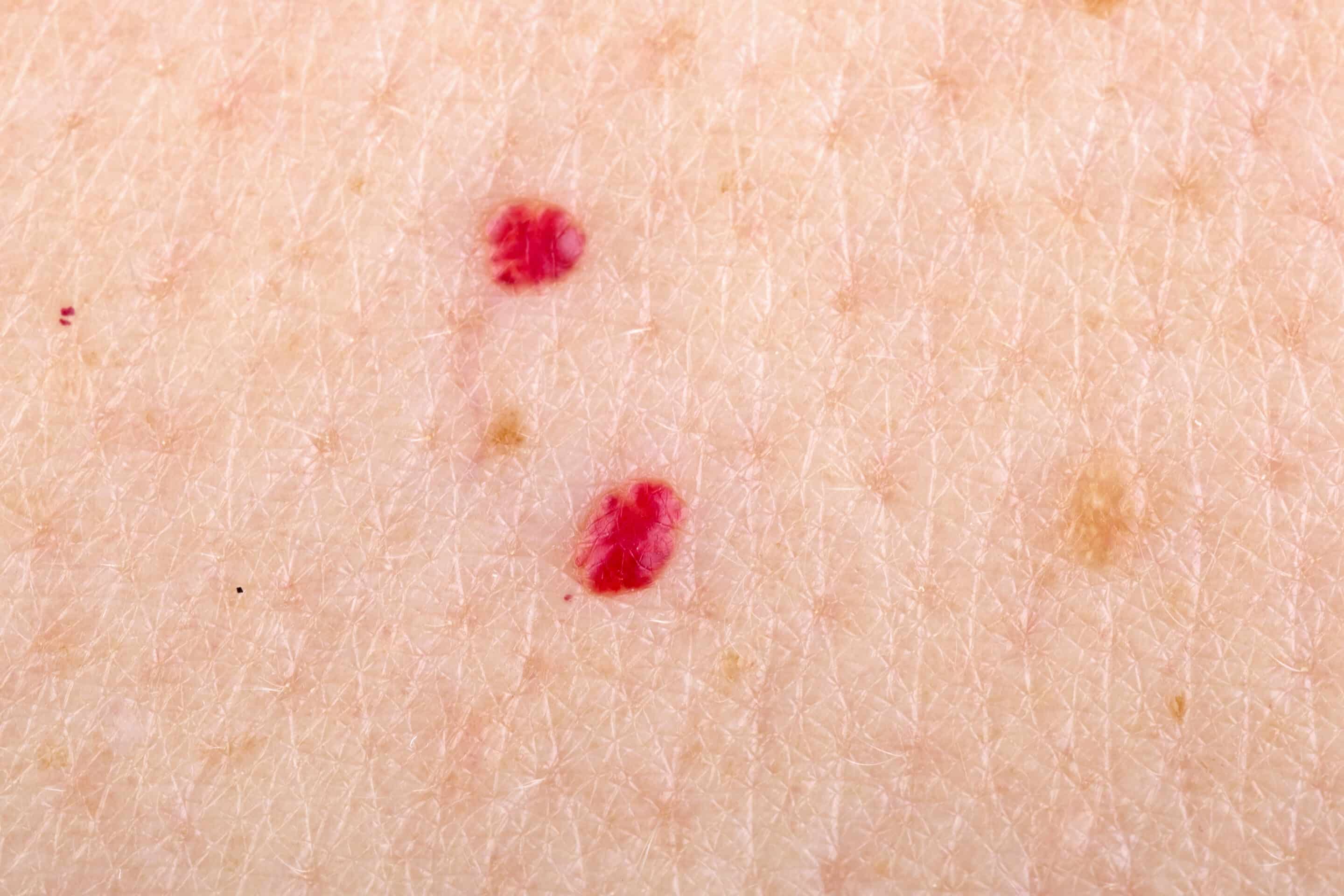 Close,Up,Photo,Of,Cherry,Angioma,On,Human,Skin red freckles on skin