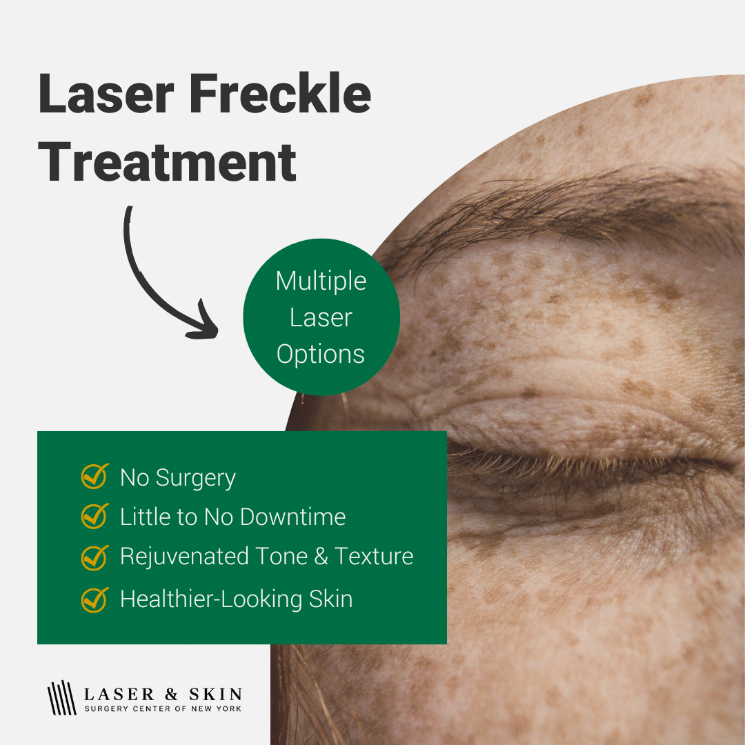 laser freckle treatments available in new york