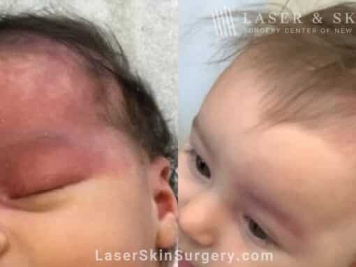 Vbeam laser to treat port wine birthmark on infant’s eye and forehead