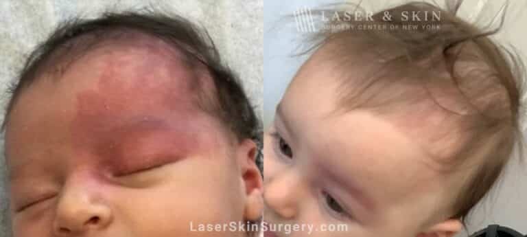 Vbeam laser to treat port wine birthmark on infant’s eye and forehead