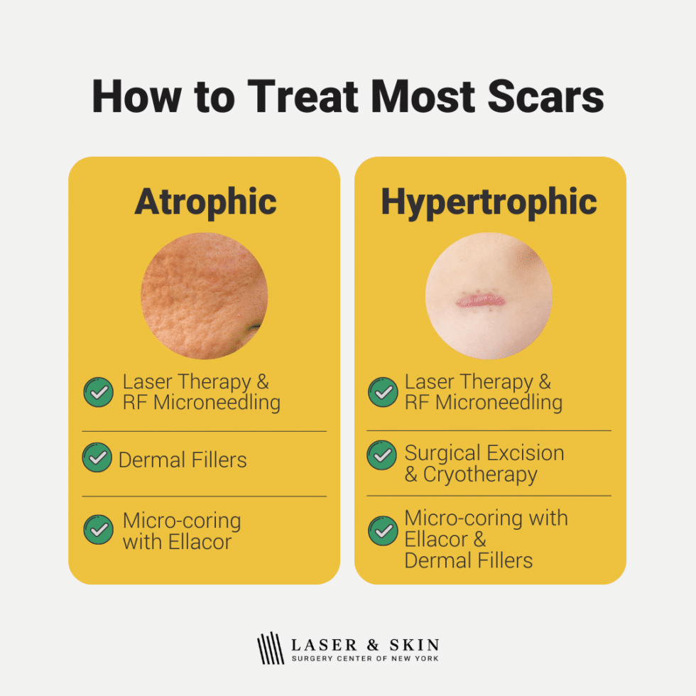Best treatments for all types of scars explained Laser NY