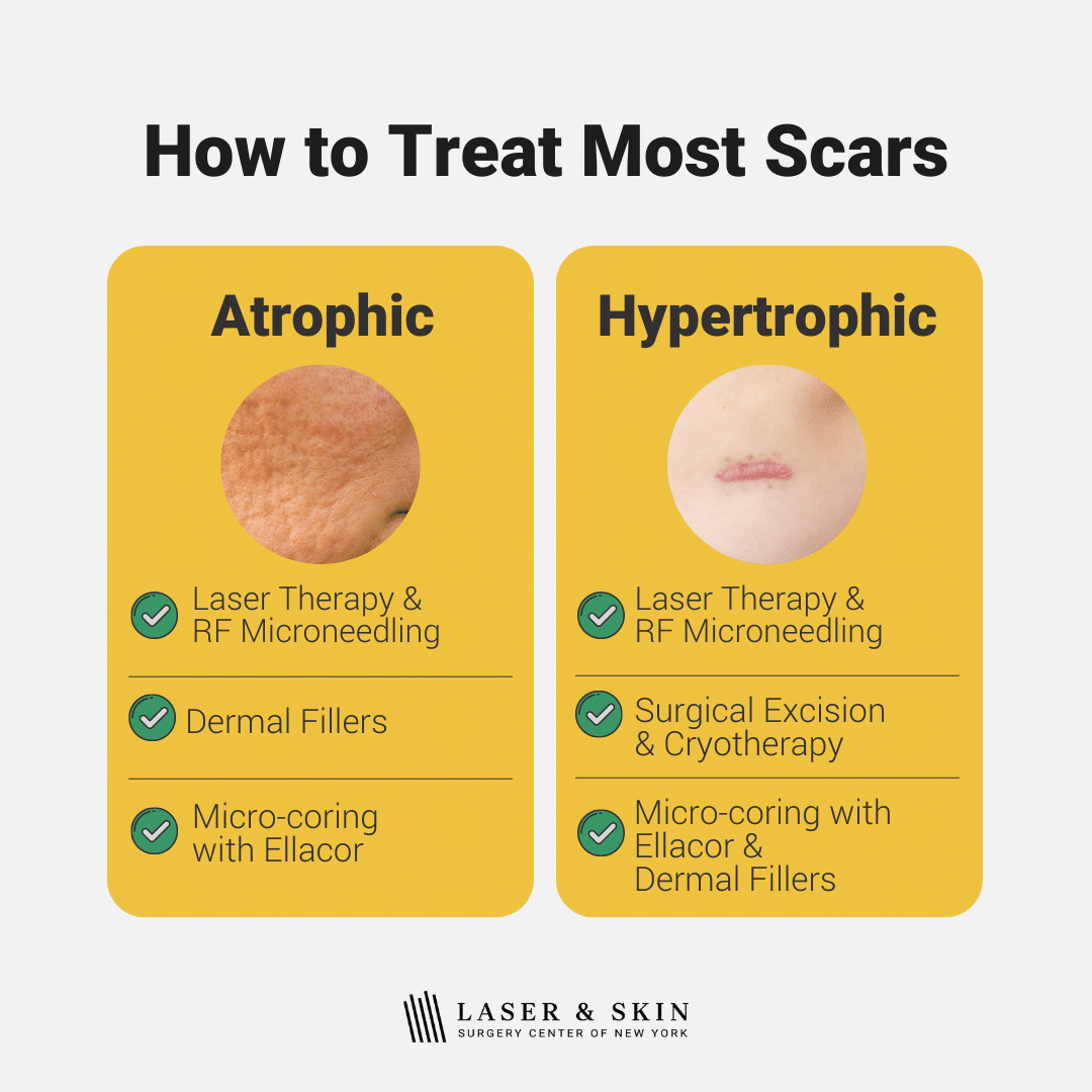 Hypertrophic Scar: Treatment, Causes, Image, and More