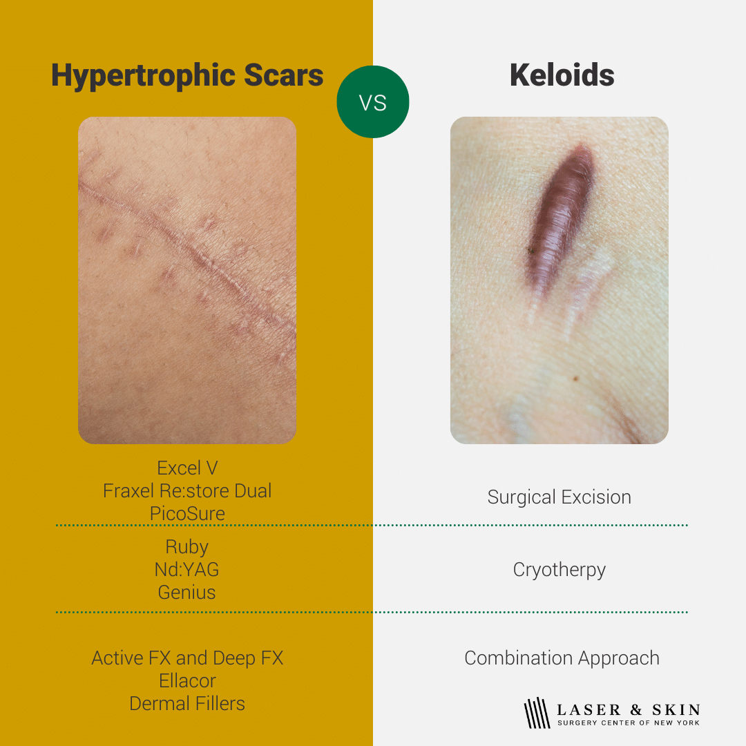 scar treatment for hyperthrophic and keloid scars