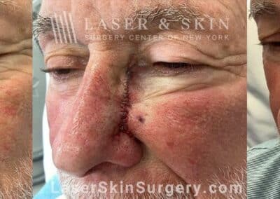 Mohs surgery to treat skin cancer on the side of the nose