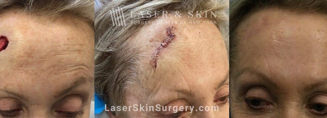 Mohs surgery to treat skin cancer on the forehead