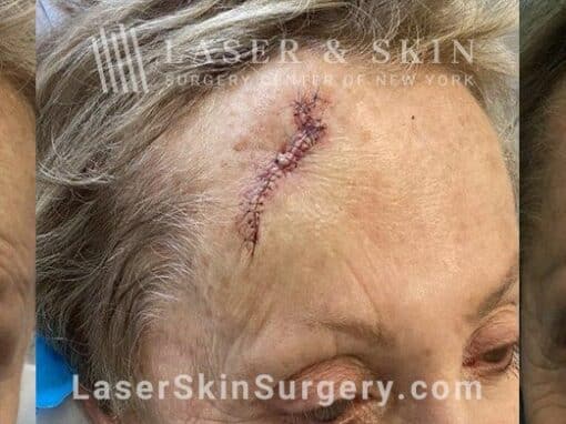 Mohs surgery to treat skin cancer on the forehead